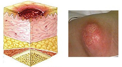 压疮最新研究成果与防治策略探讨